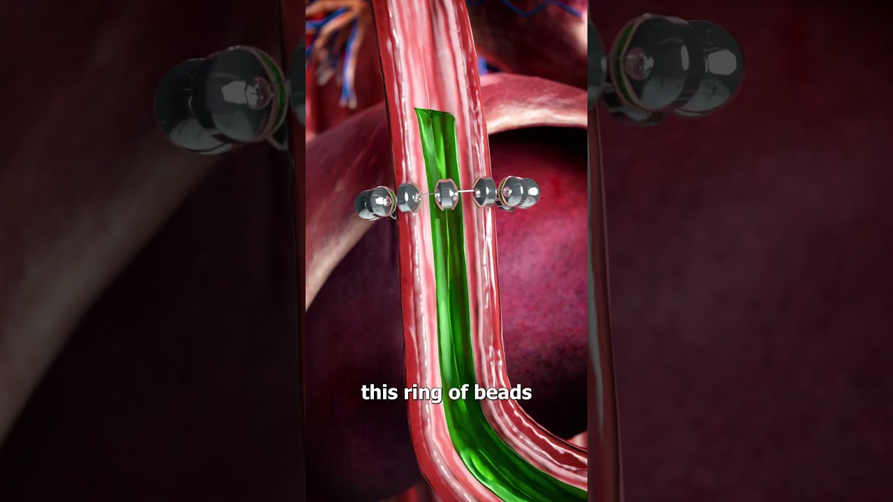 How Beads Stop Acid Reflux 😨