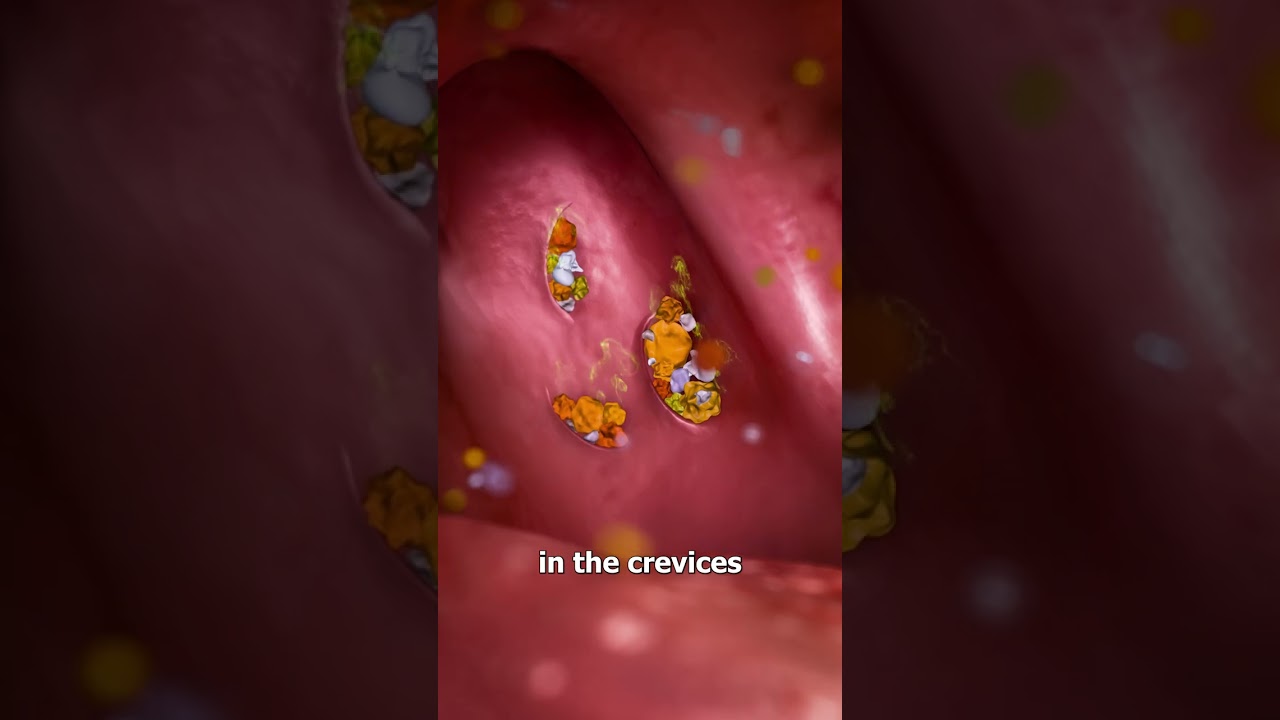 What Are Tonsil Stones? 🤔