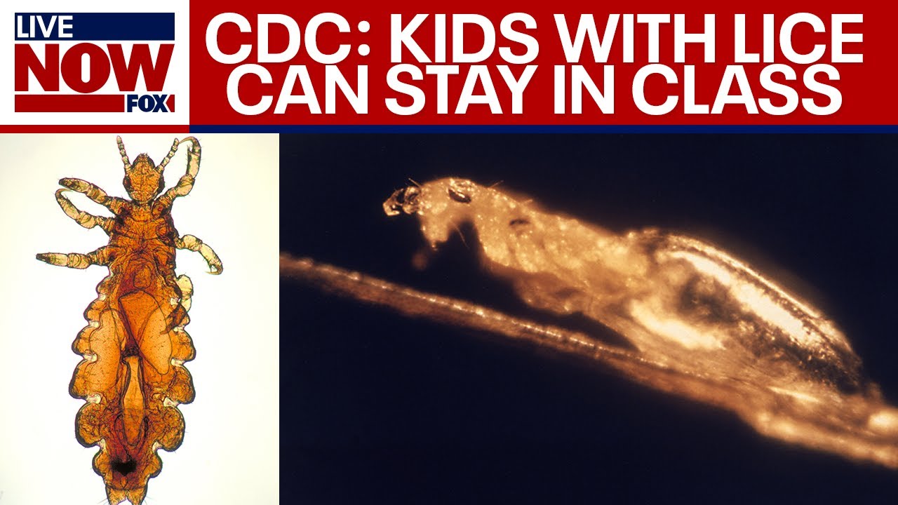 CDC: students with lice not required to be sent home | LiveNOW from FOX