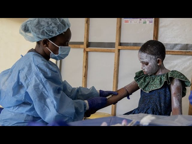 EU rules out mpox border controls and common vaccination plan