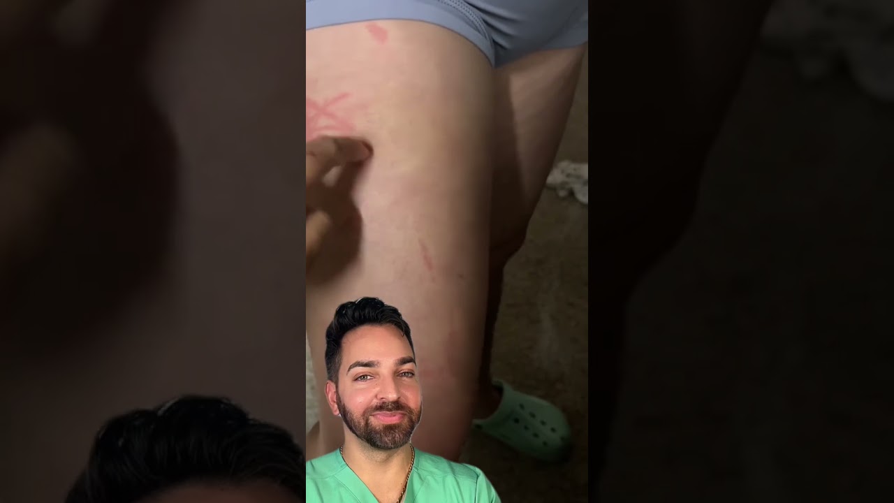 What iss thattttt? Doctorly Explains Dermatographia #shorts