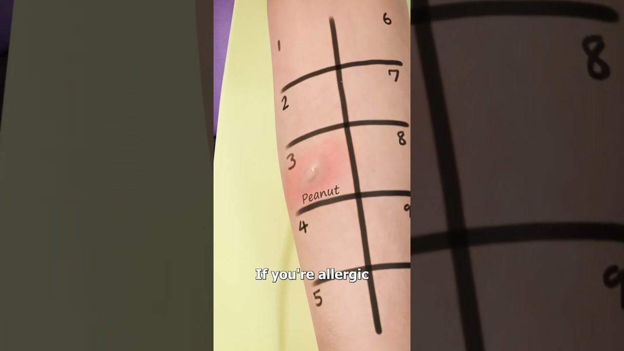 How A Skin Prick Test Works 🤔