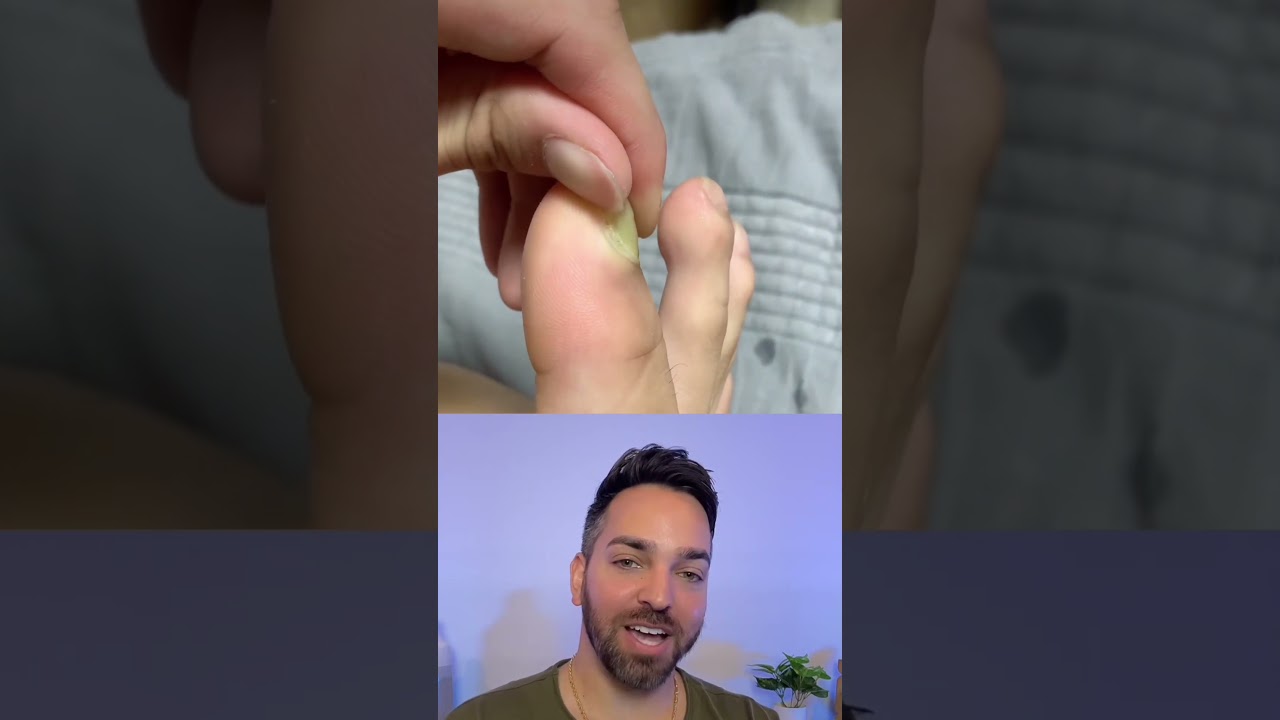 The grippers #dermatologist #toenailfungus