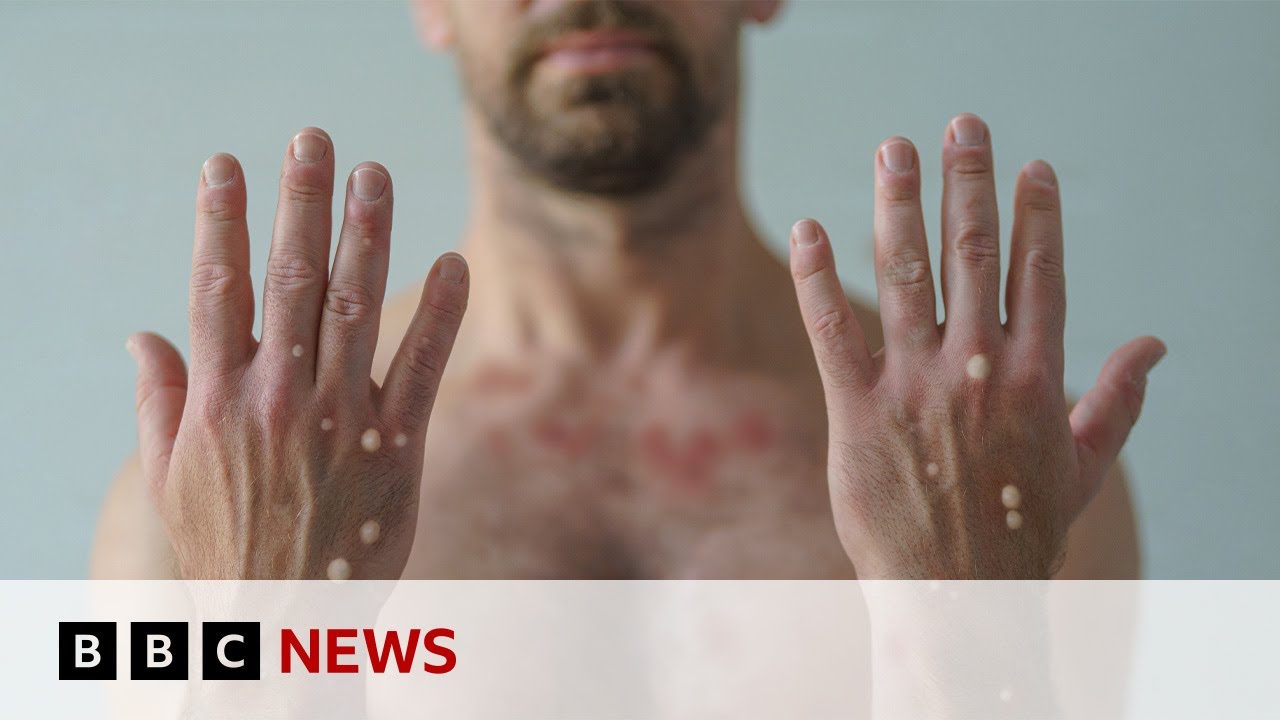 First case of more spreadable mpox detected in UK | BBC News