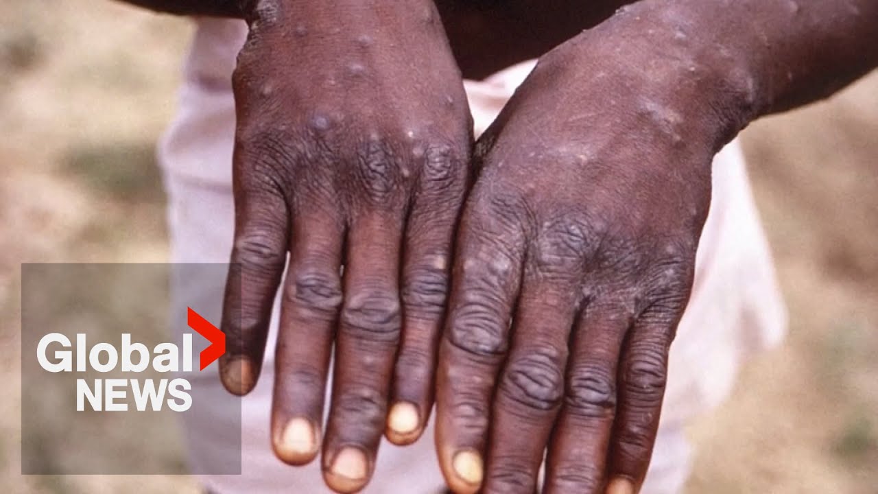 First Canadian case of more severe mpox strain confirmed in Manitoba