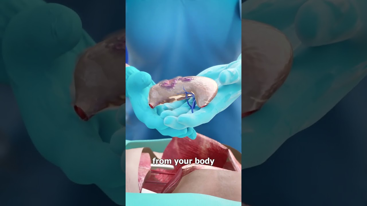 Living Without A Stomach 😮