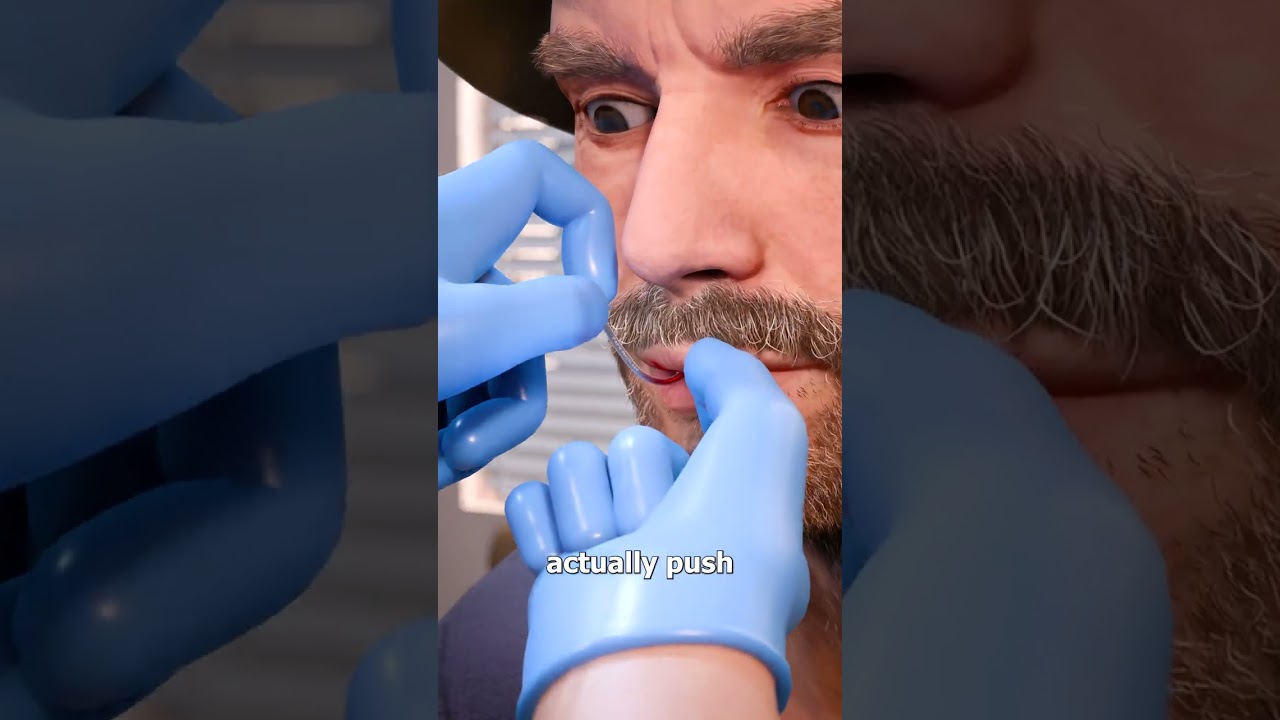 Removing A Fish Hook From Your Lip 😨
