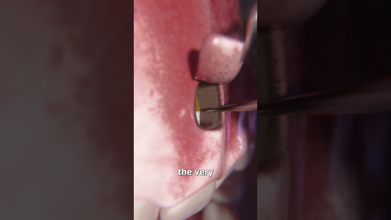 Fixing A Tooth’s Root 😮