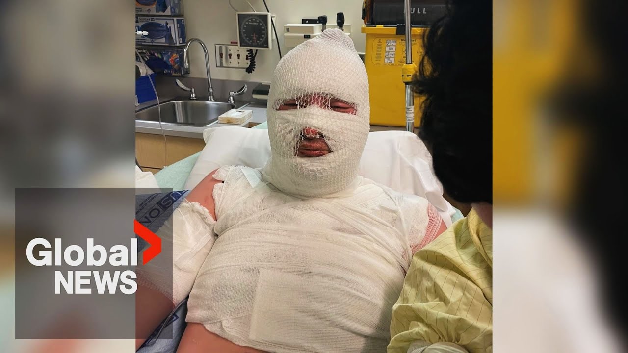 “He saved my son’s life”: Dad of Vancouver man lit on fire thanks bystander in disturbing incident