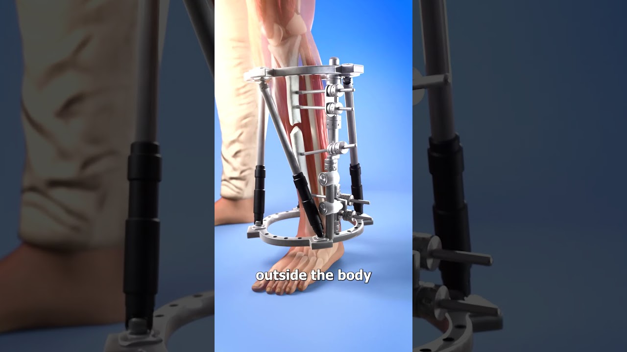 How To Stabilize A Broken Bone 🤔