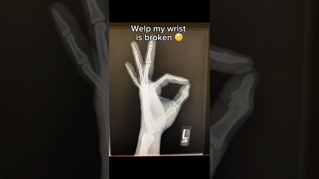 This broke my wrist 🥴 #gymnastics #gymnast #sports #fails #wrist #olympics #olympic #fail #ncaa