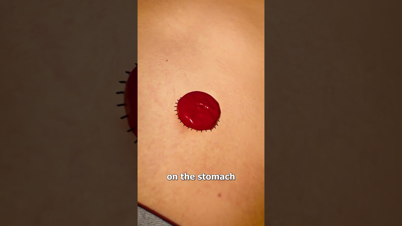 How A Colostomy Bag Works 🤔