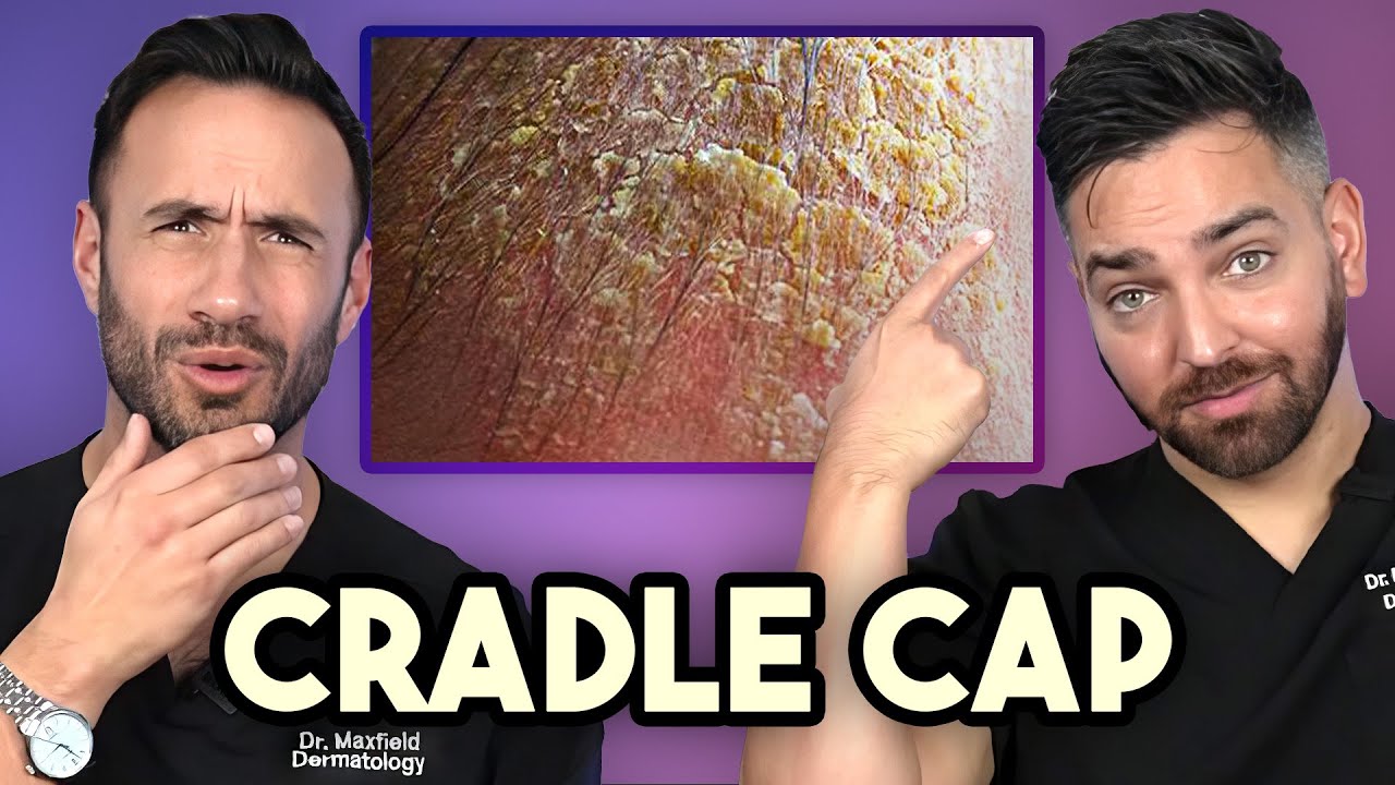 How to Treat Cradle Cap like a Dermatologist | Doctorly Dads