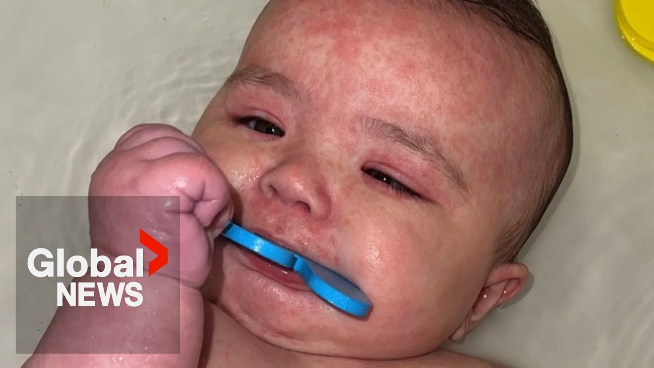 Alberta baby recovering from measles faces ‘long, painful road’