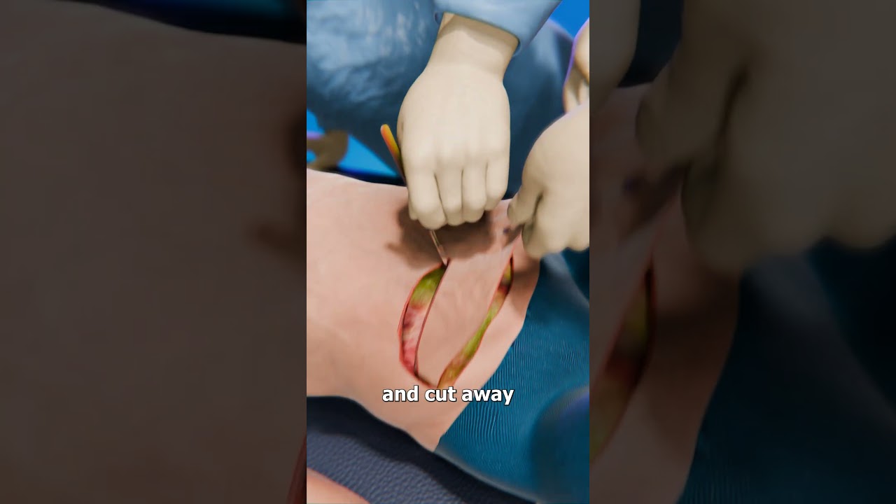 How Excess Skin Removal Surgery Works 🤔