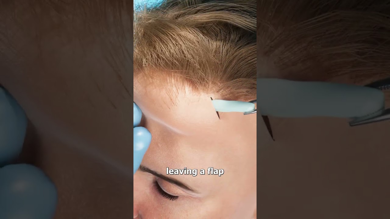 How Scalp Expansion Works 🤔