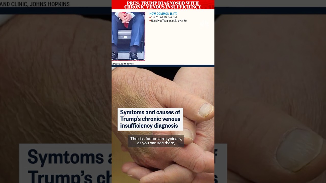 Symptoms and causes of Trump’s chronic venous insufficiency diagnosis