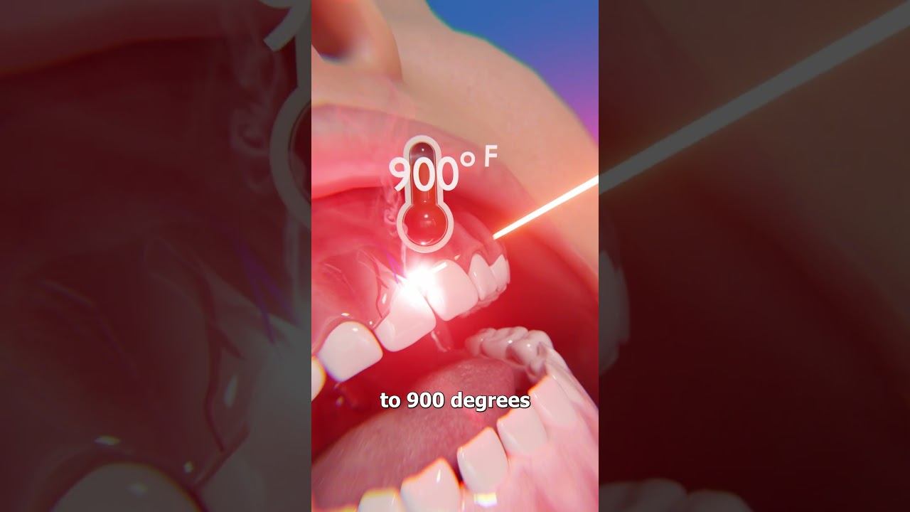 How Laser Gum Contouring Works 🤔