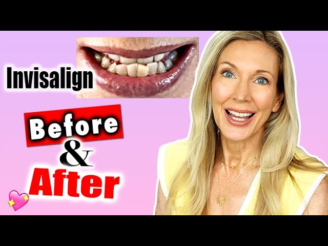 Invisalign Journey for Crowded Teeth Over 50 – Before & After!
