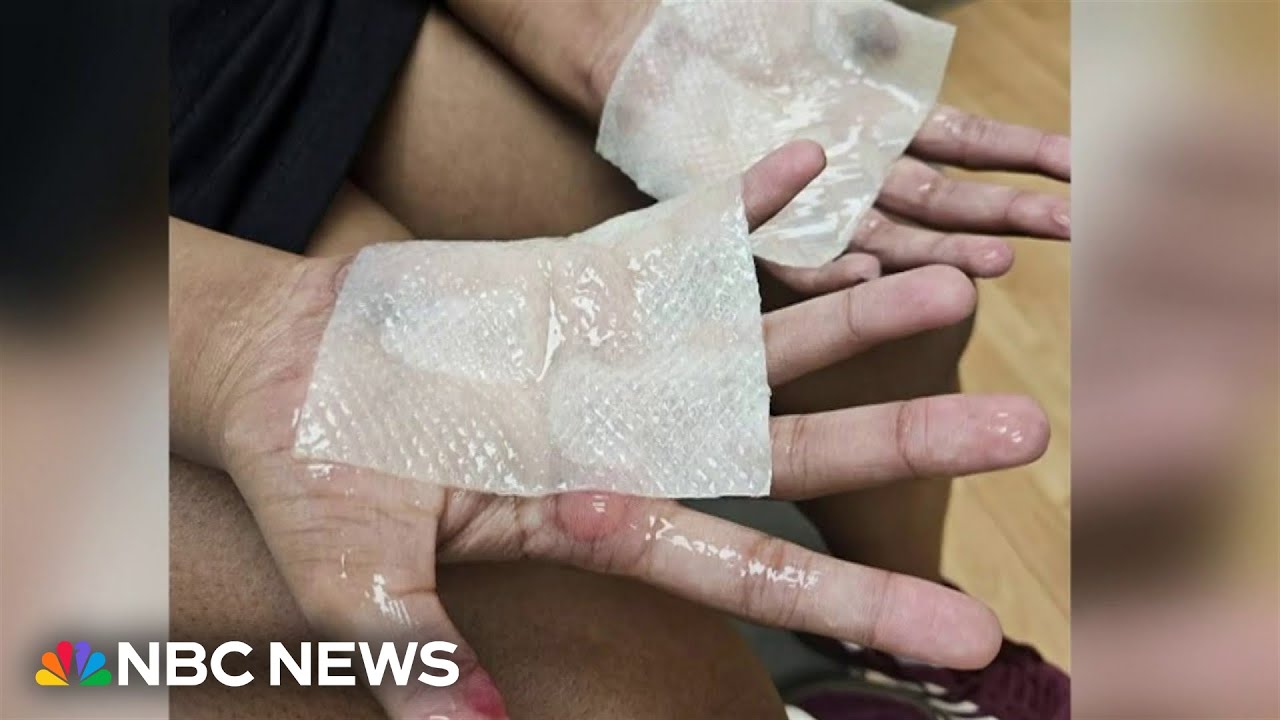 High school dance team member suffers severe burns