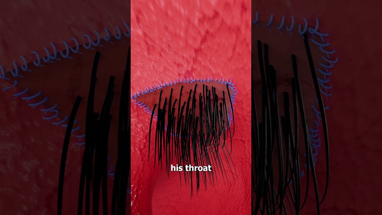 He Grew Hair Inside His Throat 😨