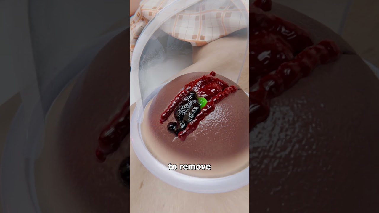 How This Suction Cup Therapy Works 🤔