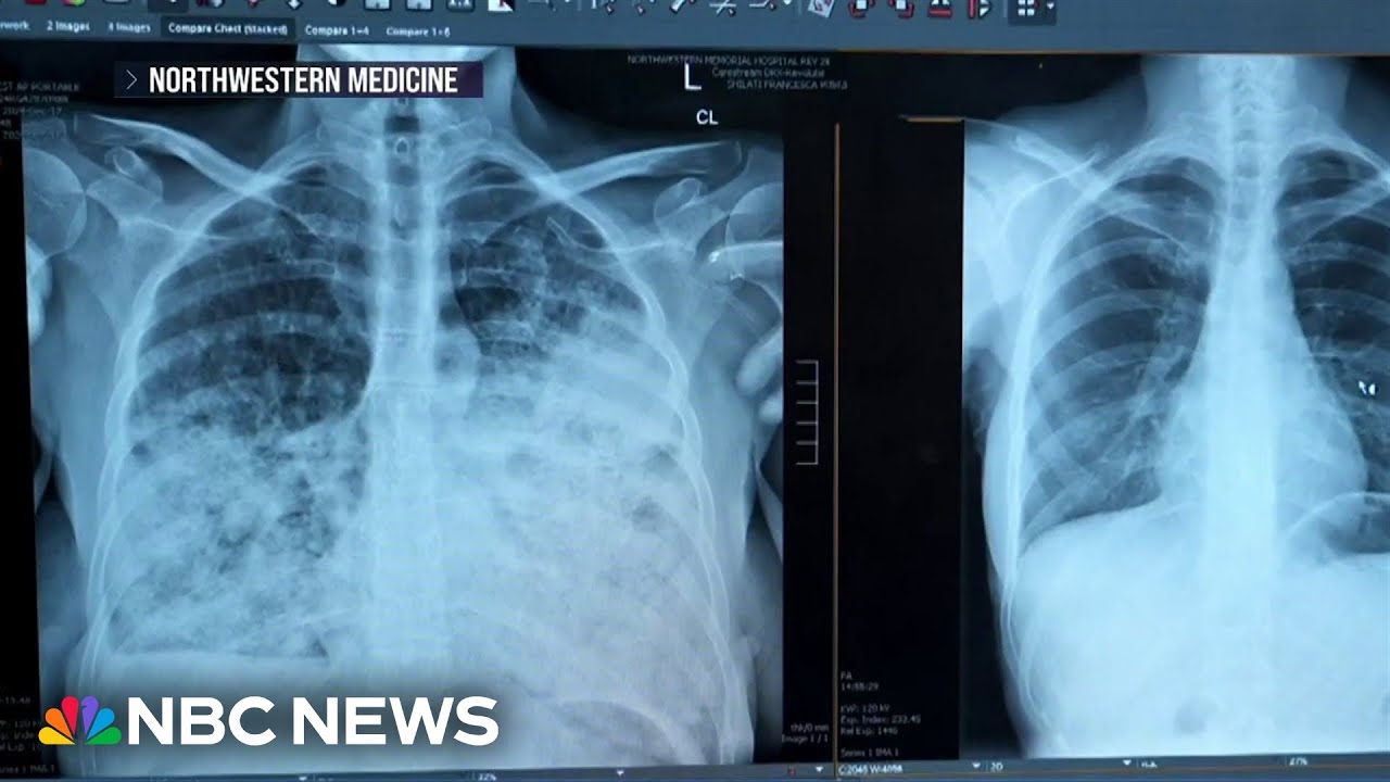 Troubling rise in young women getting lung cancer