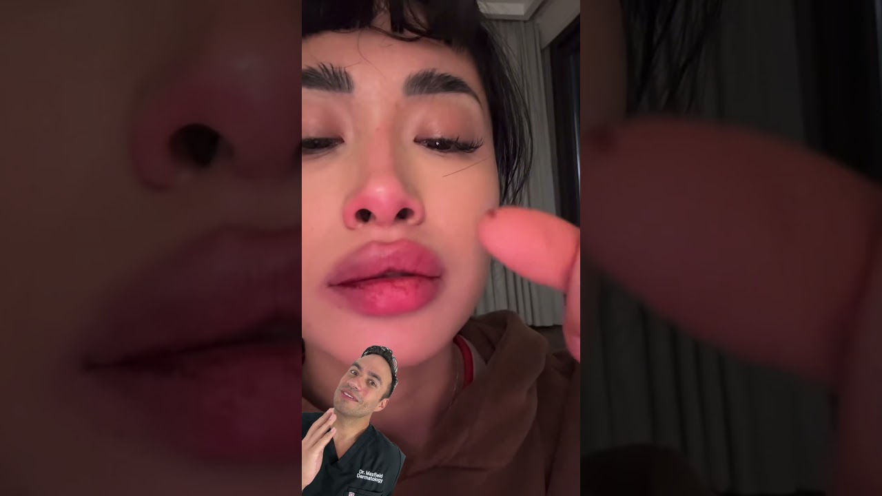 Not a Snack | How to Fix Severly Damaged Lips