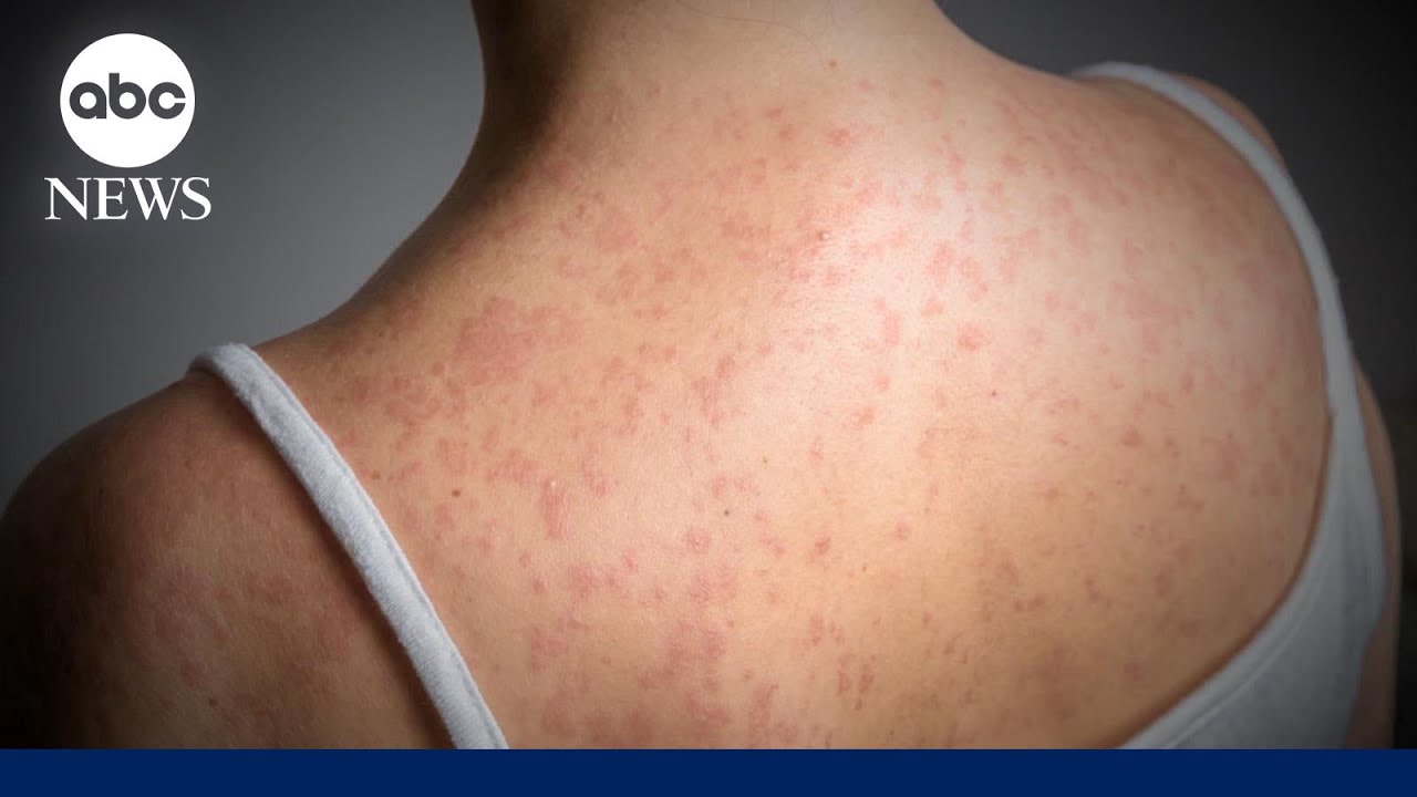 Measles cases surpass 900 in US with infections in 24 states: CDC