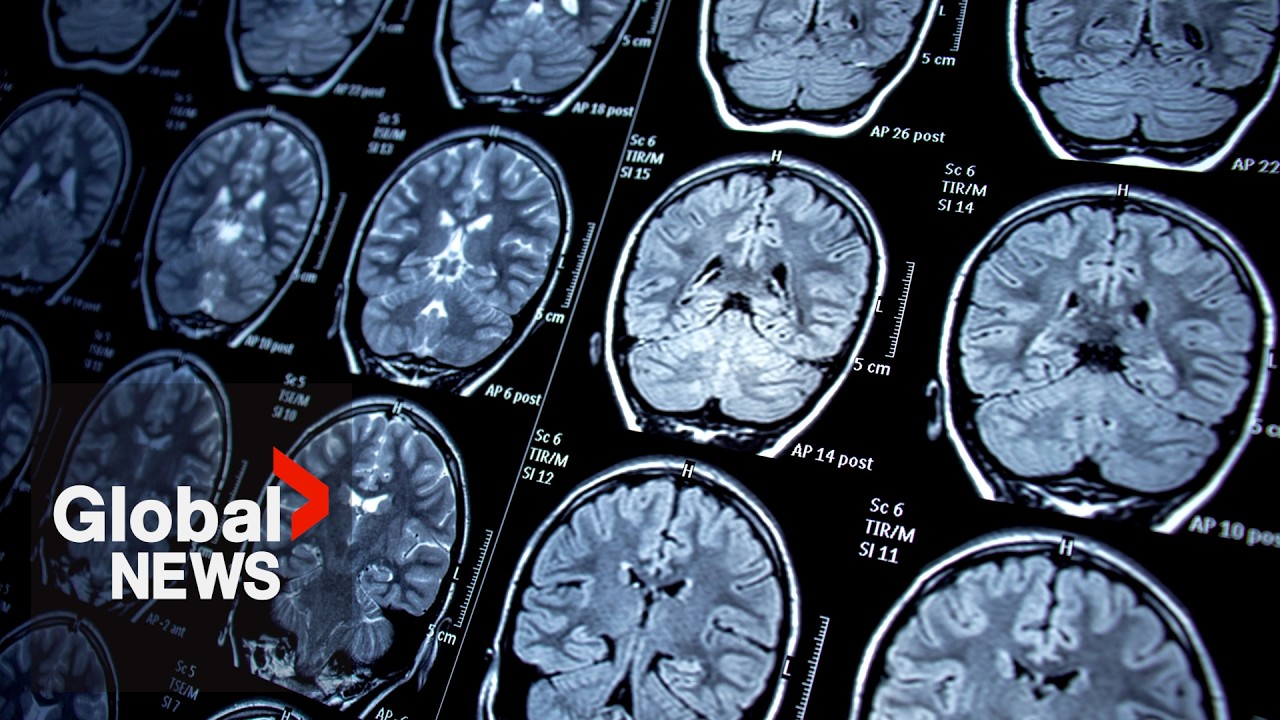 Public drug plans shouldn’t cover Alzheimer’s drug, CDA says