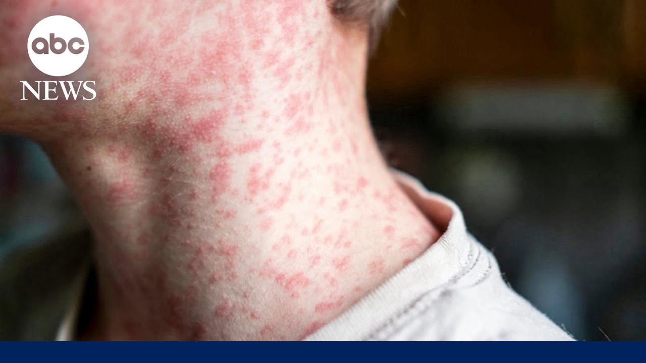 South Carolina’s measles outbreak becomes largest in US in years