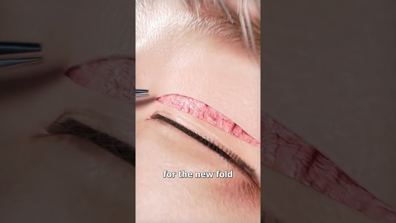 How Double Eyelid Surgery Works 😮
