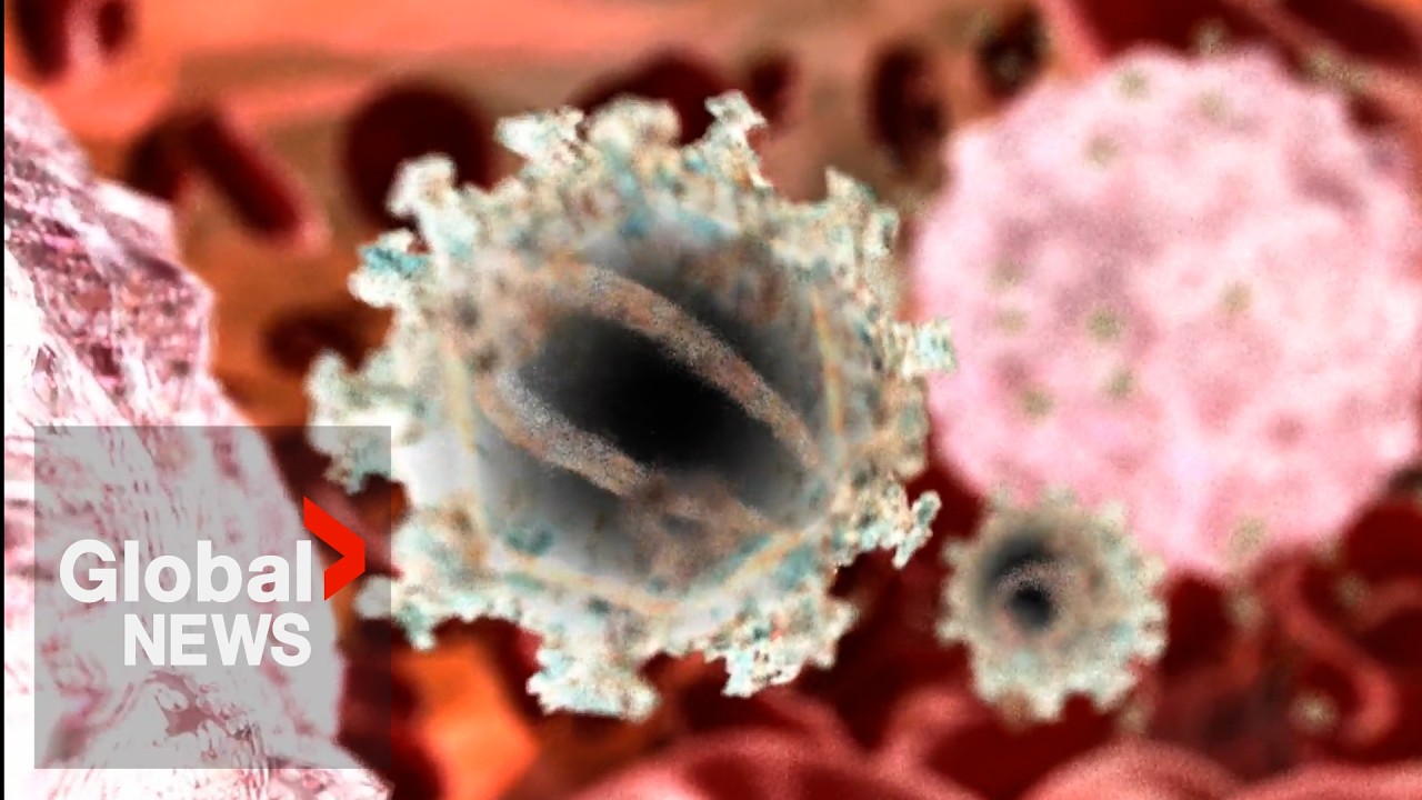 Toronto cancer patient in HIV remission after bone marrow transplant