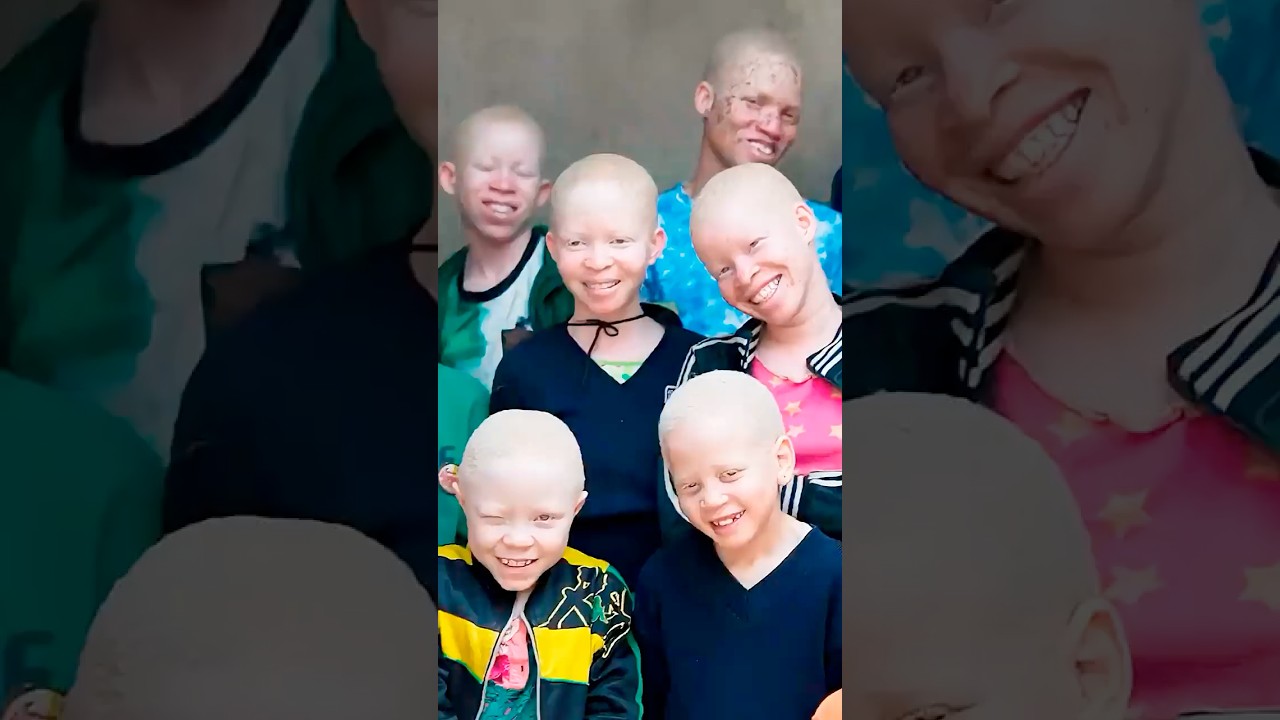 Why Albinos Are Hunted in Africa