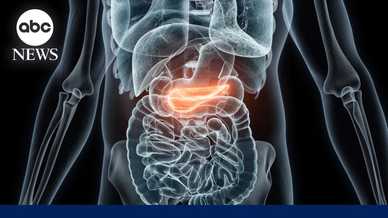 How a new drug could lengthen lives of pancreatic cancer patients