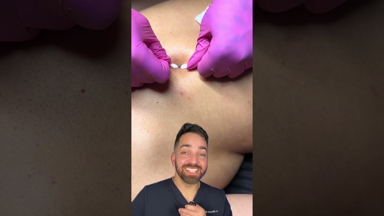 Derm Reacts to Skin Extraction | Doctorly #shorts