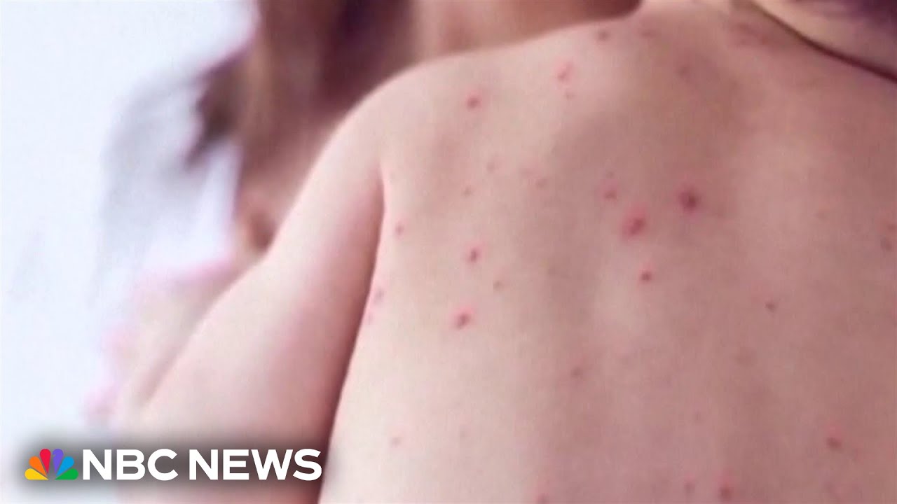 Measles cases on the rise since the start of the year 