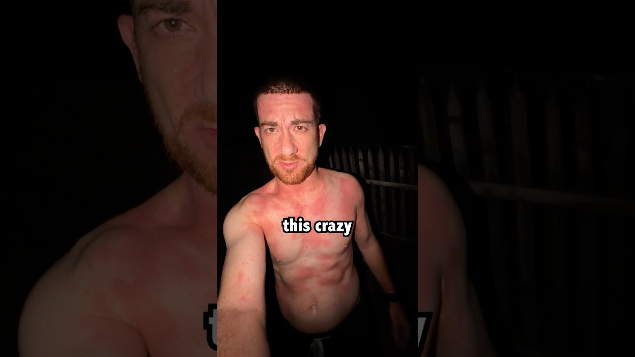 I Got A Life Threatening Rash On A Remote Island