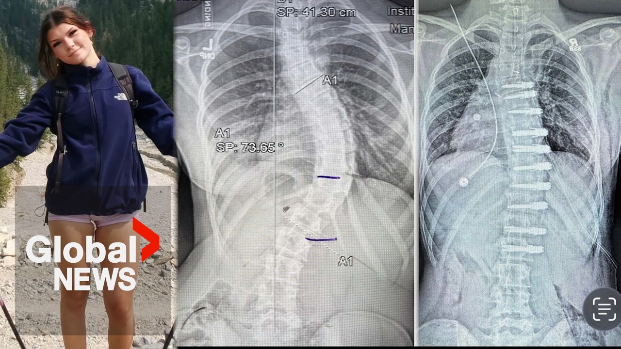 Alberta teen’s family sues government after $200K US scoliosis surgery bill