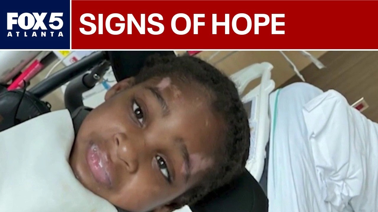 Child, 6, hit by car in Atlanta faces long recovery | FOX 5 News