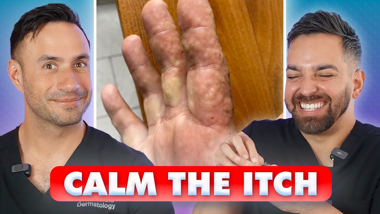 ITCHY FINGERS? Dyshidrotic Eczema: Causes, Treatment, and Prevention