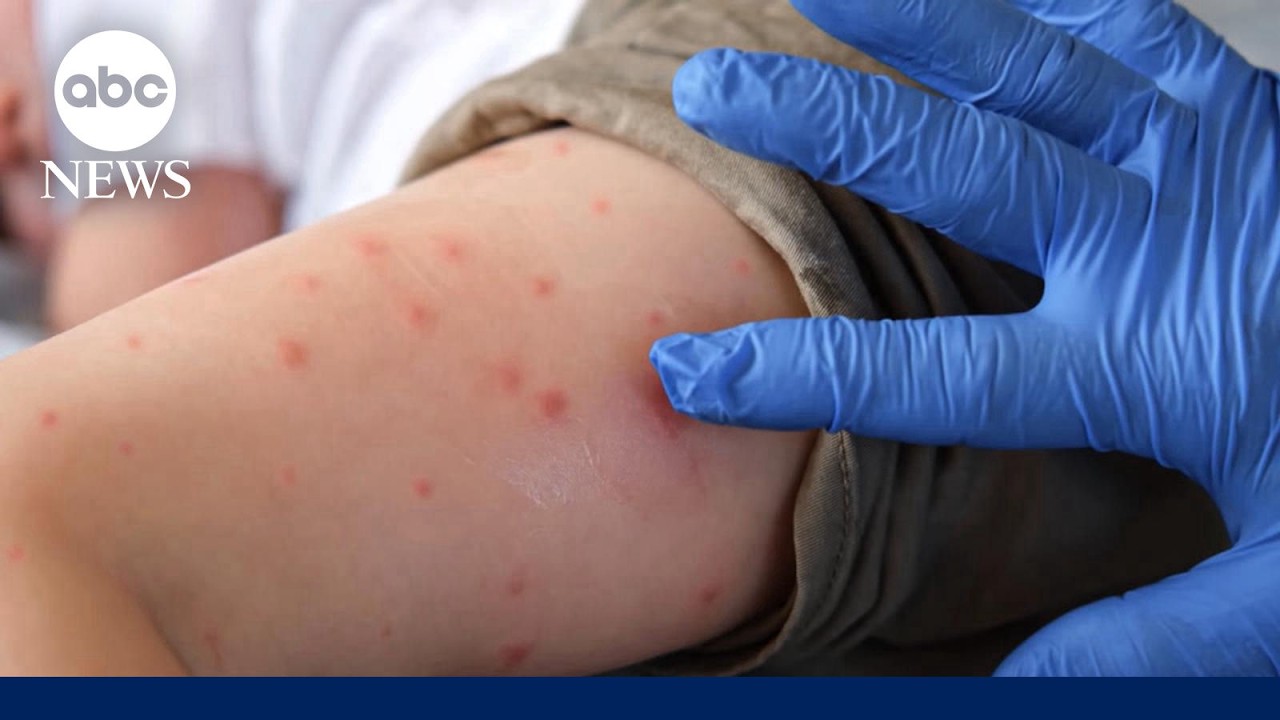 Growing Pennsylvania measles outbreak