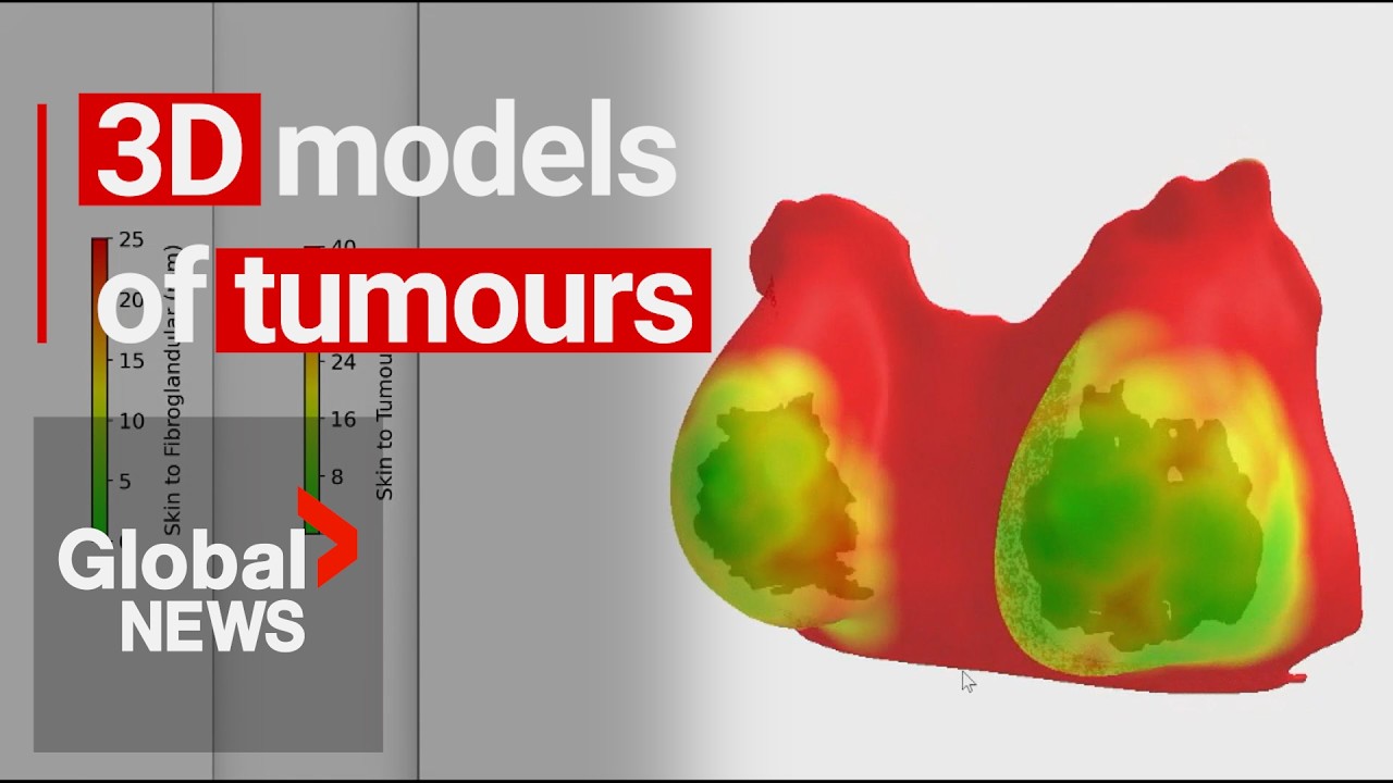 New AI tool helps create 3D models of tumours